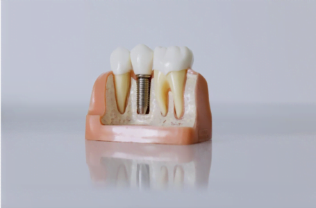 3 informații utile despre implantul dentar menite să răspundă întrebărilor tale